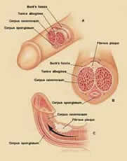 Induratio penis plastica (IPP).